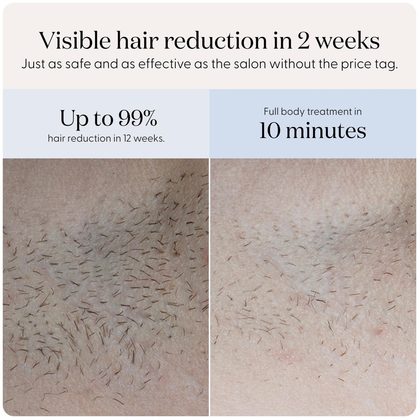 At-Home IPL Hair Removal Device for Face & Body